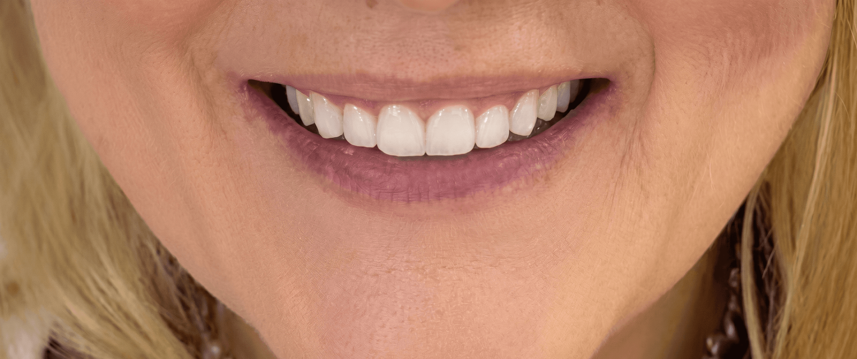 Minimal digital smile design workflow