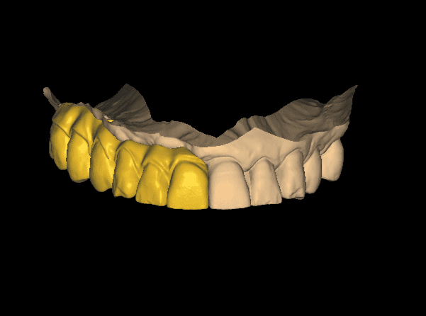 Minimal CAD CAM dental integration detail
