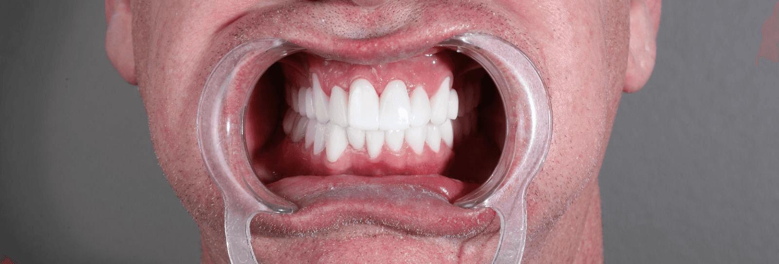 Clean dental restoration design model